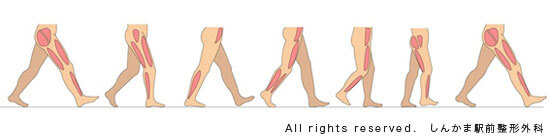 歩行を見ることで痛みの原因がわかることがあります。歩行時に地面を踏みしめてから蹴り出すまで使われている筋肉が違うためです。そして痛みの原因はインソールを使用することで軽快することがあります。</