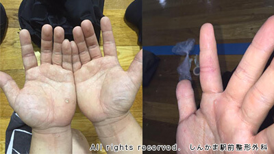 左人差し指の第2関節に腫れと内出血が見られました。